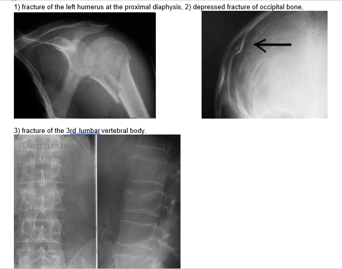 a case study on bone tissue structure and repair