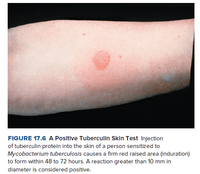 Answered: FIGURE 17.6 A Positive Tuberculin Skin… | bartleby